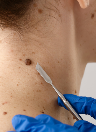 Birthmark Removal in Surat