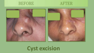 Cyst removal surgery