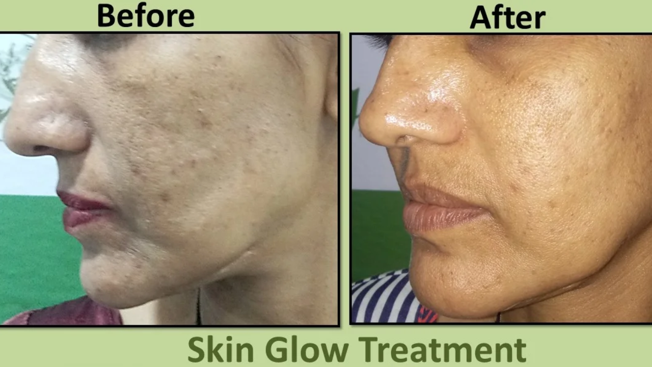 Skin brightening treatment