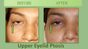 Upper eyelid correction