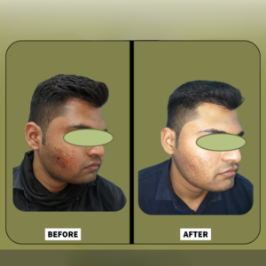 Before and after — aesthetic result