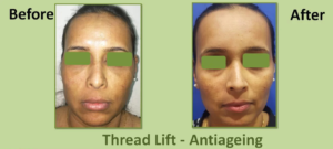 Antiageing Treatment Before After