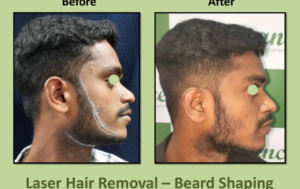 Beard Shaping Before After
