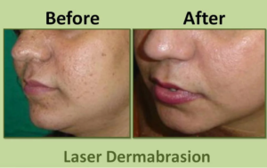 Before and After Laser Treatment