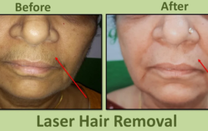 Before and After Results