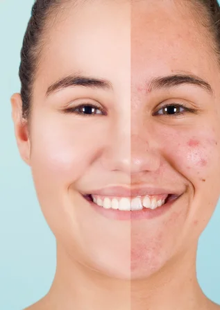 Best Acne and Pores Treatment treatment in Surat