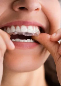 Best Clear Aligners treatment in Surat