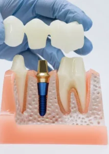 Dental crowns and bridges treatment in Surat