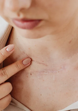 Scar Revision in Surat