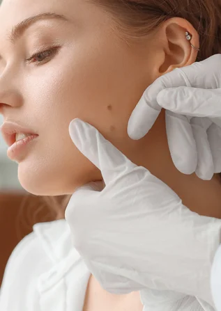 Scars, Cyst & Mole Removal in Surat