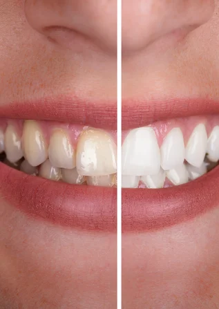 Best Teeth Whitening Or Teeth Bleaching treatment in Surat