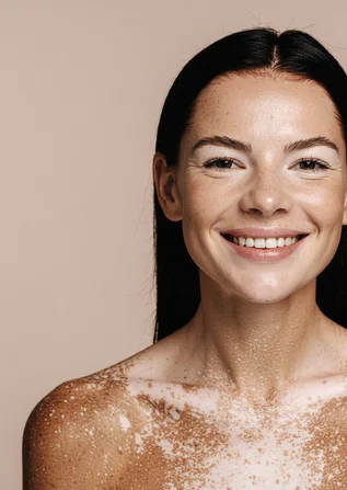 Vitiligo Surgery in Surat