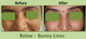 Botox Bunny Lines Before After