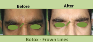 Botox Frown Lines Before After
