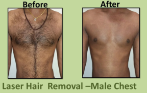 Laser Hair Removal Before After Results
