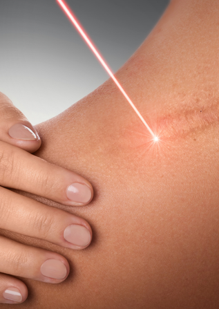 Keloid Laser Treatment in Surat