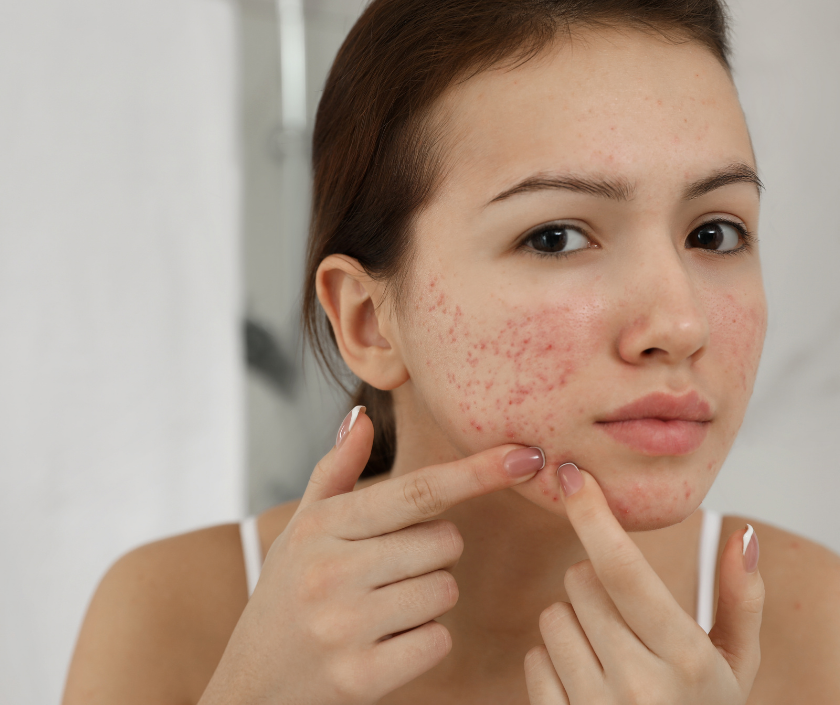 Non-surgical Filler for Acne & Scar in Surat