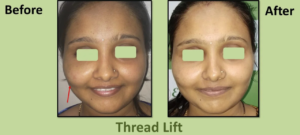 Thread Lift Before After
