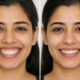 smile me gums kam kaise kare