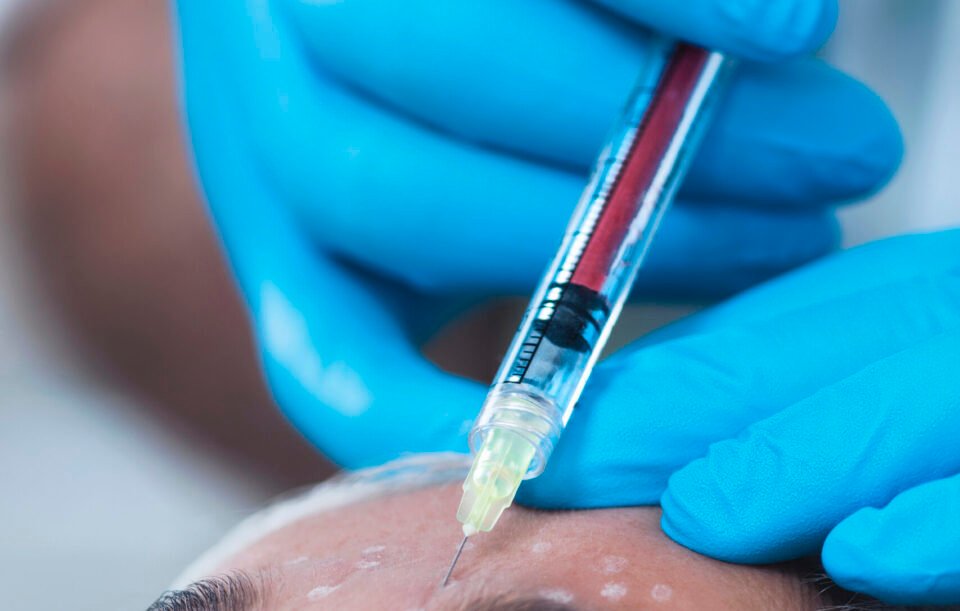 Best PRP Facial for Natural Skin Rejuvenation