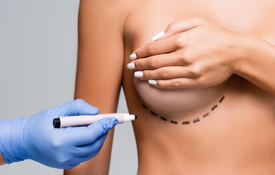 Cropped view of doctor in latex glove holding marker near naked woman with marks on breast isolated
