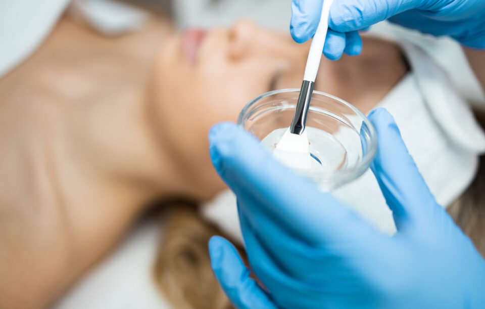 Chemical Peel off Treatment
