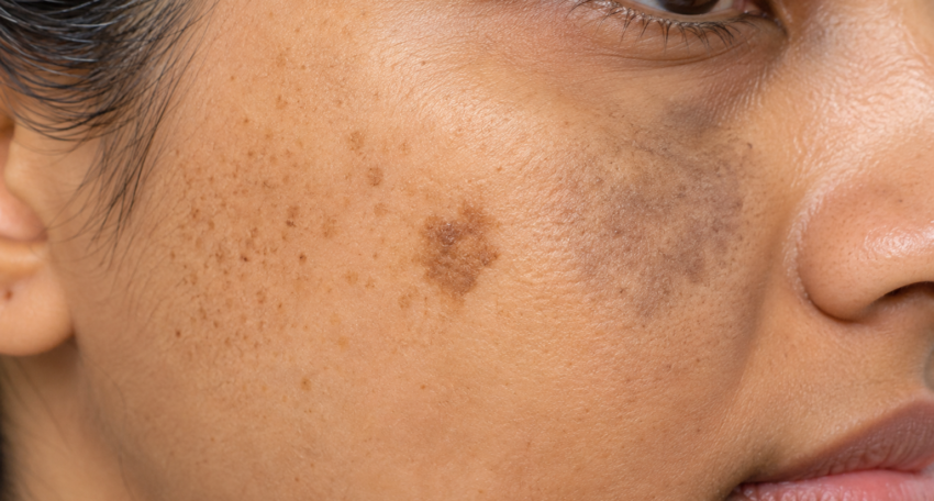 Clinical Close-Up of Pigmented Facial Skin