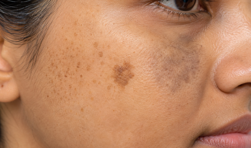 Clinical Close-Up of Pigmented Facial Skin