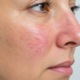 Close-Up of Facial Capillaries