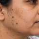 skin wart removal