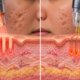 Fractional Laser vs RF Microneedling