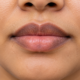 lip lightening laser treatment